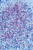 Infectious Diseases Products Infectious Diseases Products